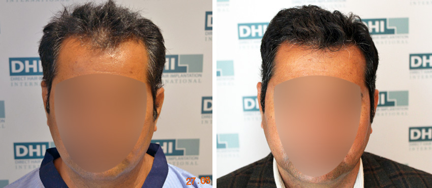 DHI before & after hair transplant results